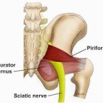 Sciatica - The Mother of all Pains By Cheryl Alker